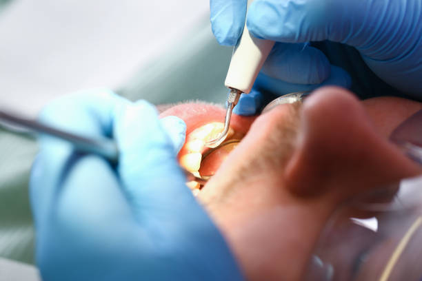 Best Dental Abscess Treatment in Carrollwood, FL