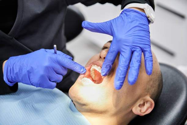 Best Emergency Wisdom Tooth Extraction in Carrollwood, FL